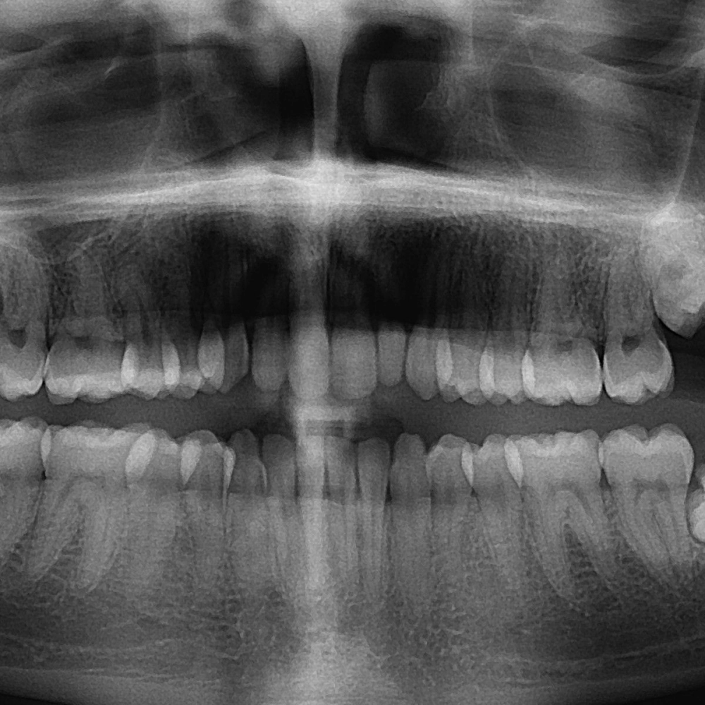 Wisdom Tooth Surgery